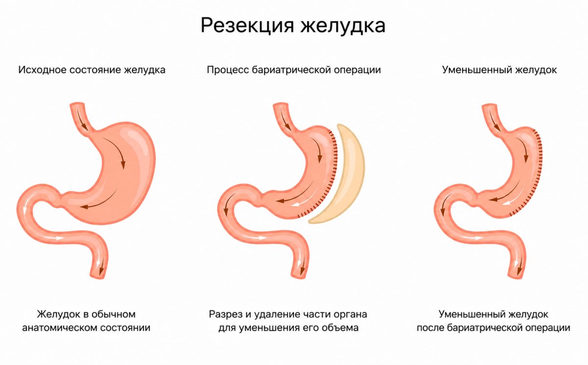 Медицинская схема лапароскопической продольной резекции желудка (Sleeve Gastrectomy): желудок до операции, этап удаления части желудка и результат после операции