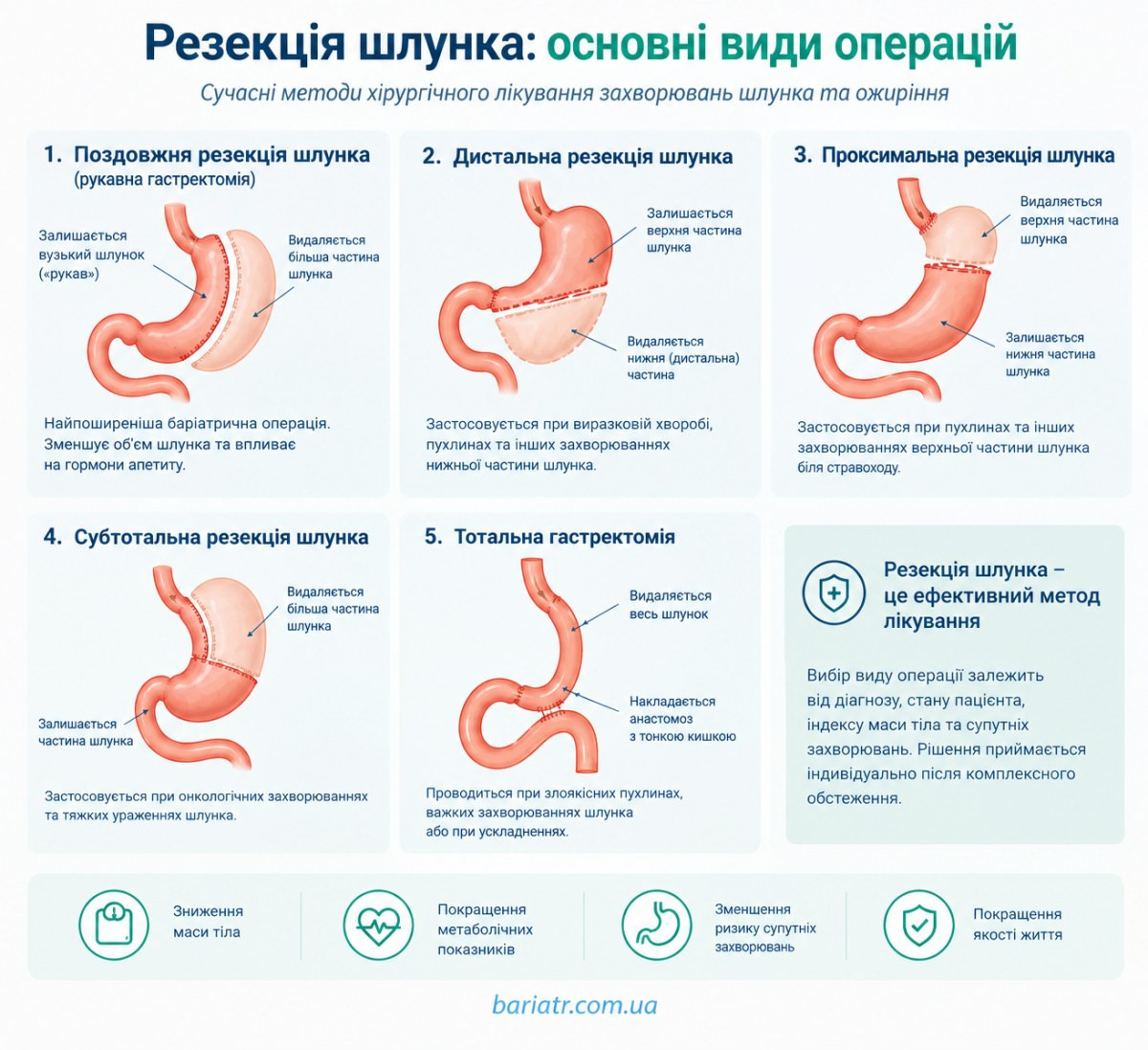 Резекція шлунка: основні види операцій