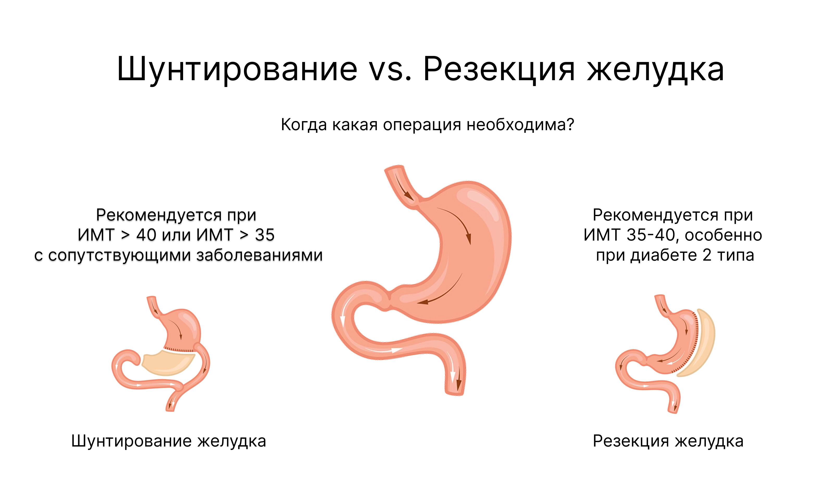Шунтирование и резекция желудка: сравнительная иллюстрация